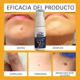 Eliminador de Verrugas y Lunares Wart Remover™ Elimina Con Suavidad y Rapidez